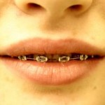 Braces Braces